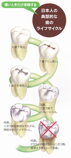 歯のライフサイクル（悪）.jpg